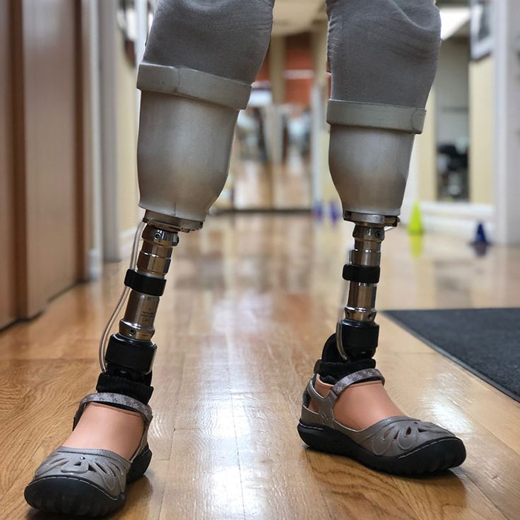 Hip Disarticulation Prosthesis