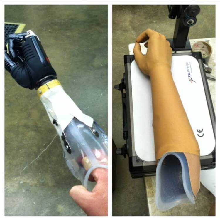 Above-Elbow Prosthetic Hand