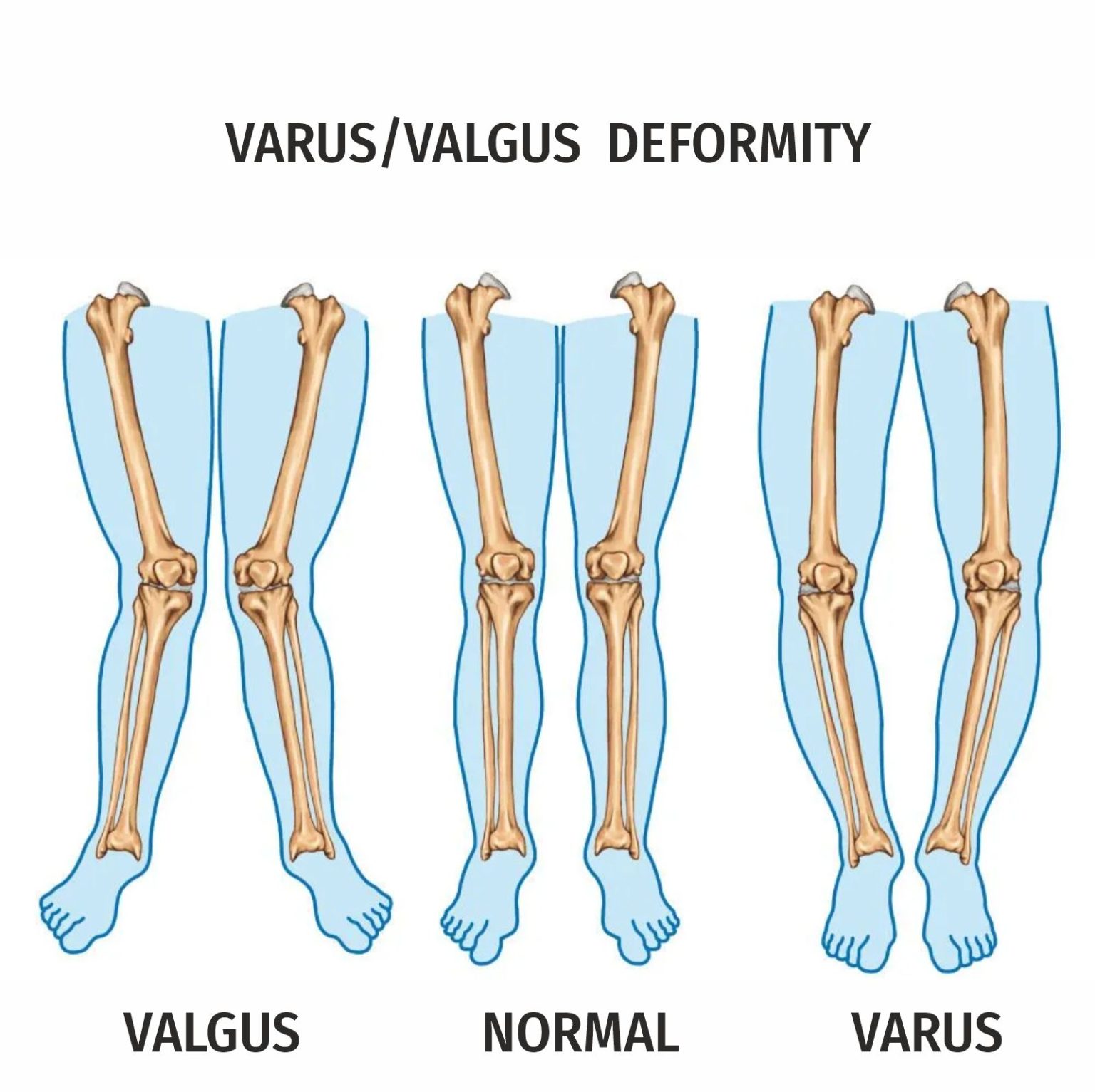 Плоскостопие с вальгусной деформацией стопы. Вальгум. Вальгум. Вальгусная деформация большого пальца стопы( hallux valgus. Вальгусная деформация стопы у детей.