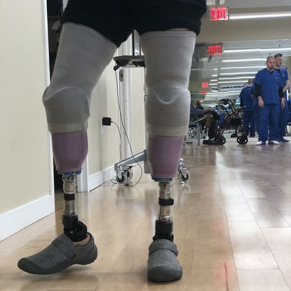 Lower limb prosthetics Dubai