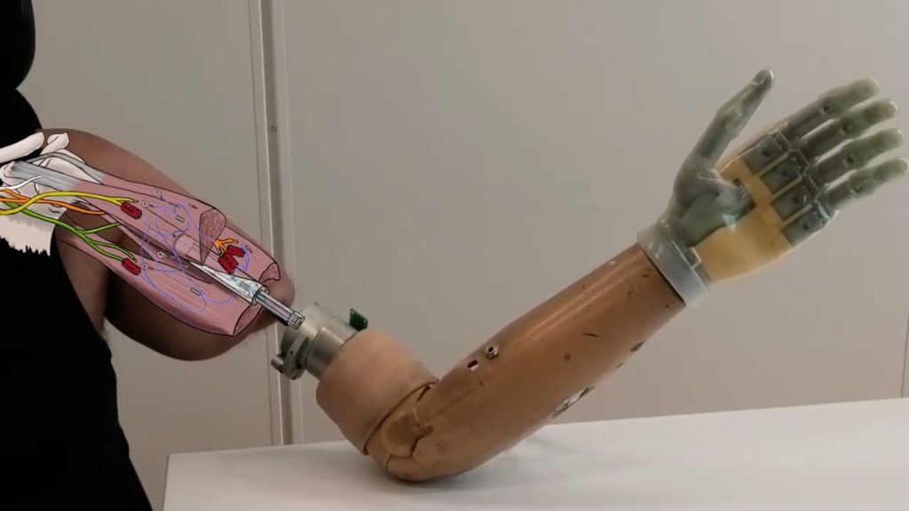 Below-Elbow Prosthetic Hand